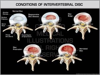 Conditions of intervertebral disc