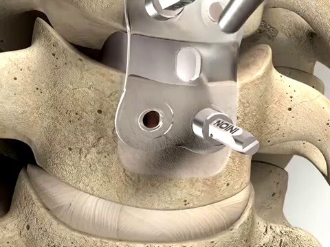 a metal plate screwed into the vertebrae
