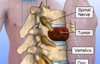 Tumor Removal