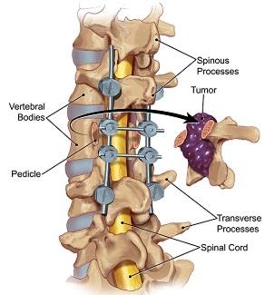 Spinal Tumor
