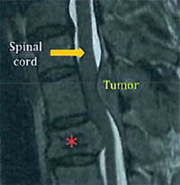 Spinal Cord Tumor