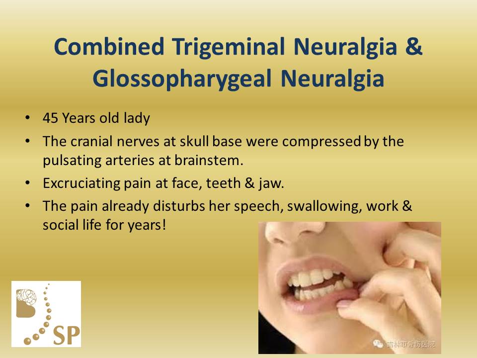 Trigeminal Neuralgia Surgeon Case