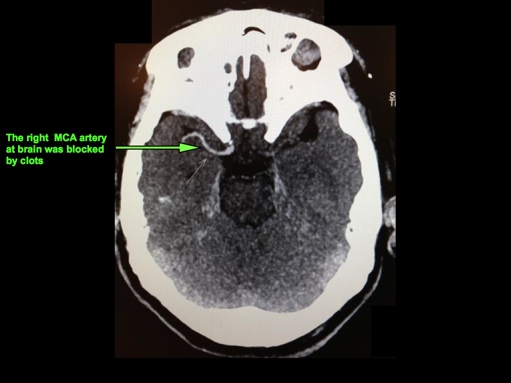 Acute Stroke Recovery Case