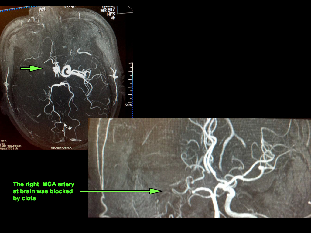 Acute Stroke Recovery Case