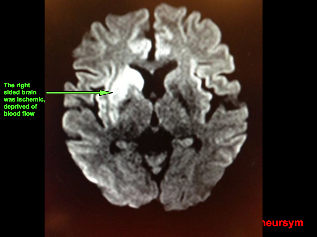 Acute Stroke Recovery Case