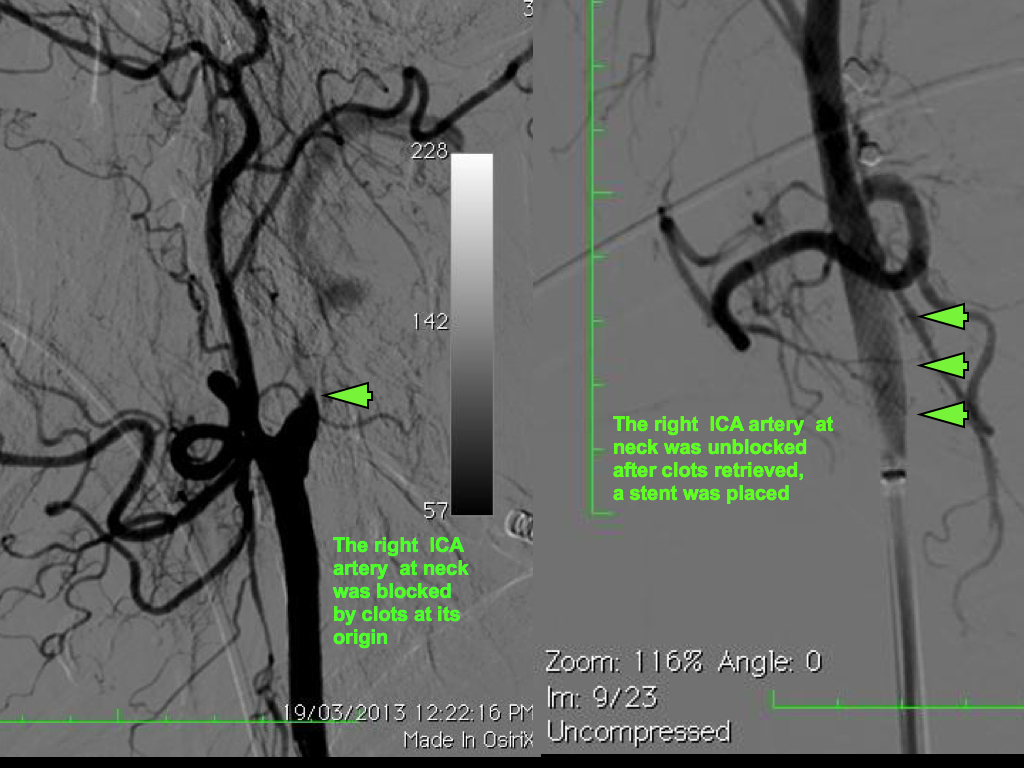 Acute Stroke Recovery Case