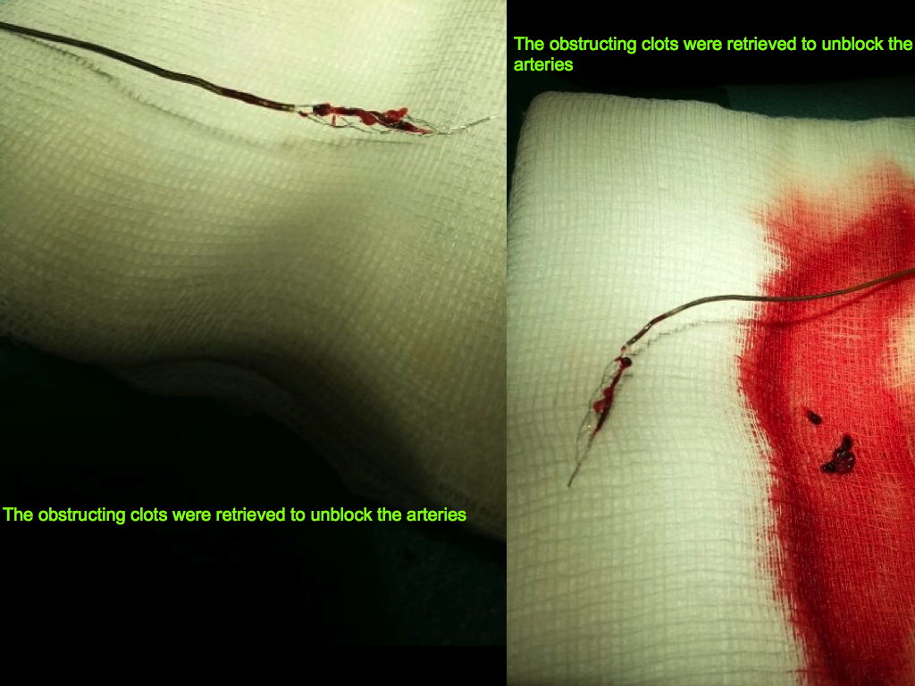Acute Stroke Recovery Case
