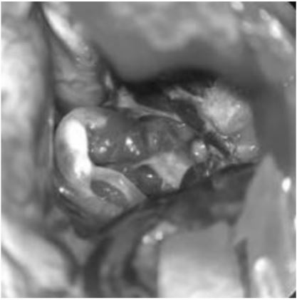 endovascular therapy