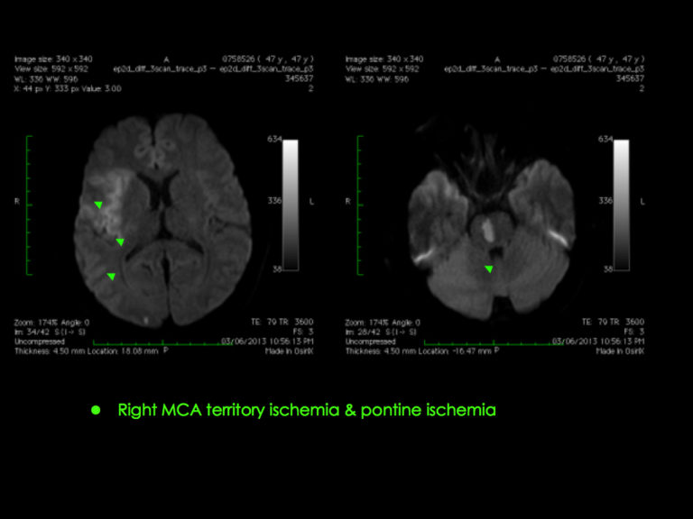Middle Cerebral Artery - MCA1