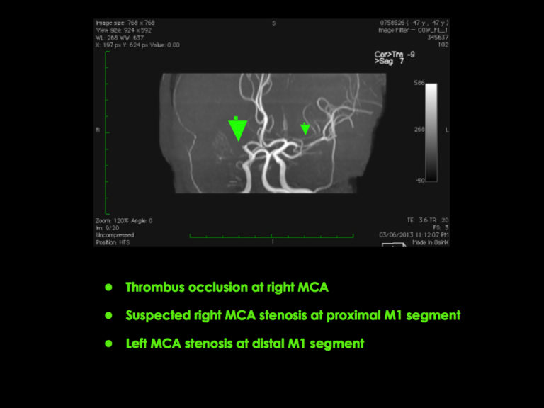 Middle Cerebral Artery - MCA2