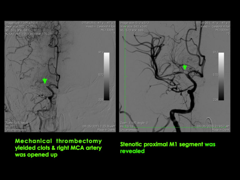 Middle Cerebral Artery - MCA4